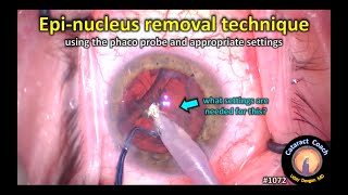 CataractCoach 1072: epi-nucleus removal technique with the phaco probe