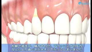 【歯ぐき下がりのお悩みに】3D動画でわかる根面被覆術（CTG)