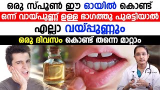 വായ്പുണ്ണ് മാറാൻ ഈ ഓയിൽ അവിടെ പുരട്ടിയാൽ മതി  | vaaypunn maran | Dr Priya