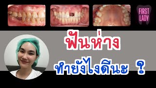 6 วิธีแก้ไขฟันห่าง มีช่องว่าง FUNFUN story EP. 22