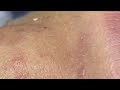 big cystic acne blackheads extraction blackheads u0026 milia whiteheads removal pimple popping 1620