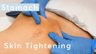 Skin Tightening Stomach - HIFU Ultraformer III Treatment