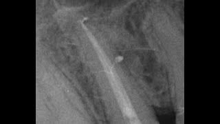 How to obturate Lateral Canals: a case study - Re-Root Treatment | I ❤️ the pulp