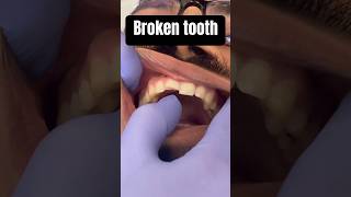 Trauma and broken tooth!         #memes #dentist #fyp #emergency #viral #shorts #youtubeshorts #pov