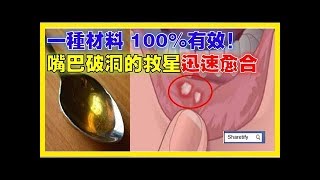 「嘴巴破洞」的救星來了！在口瘡上塗「它」100%有效，迅速治癒還超省錢！