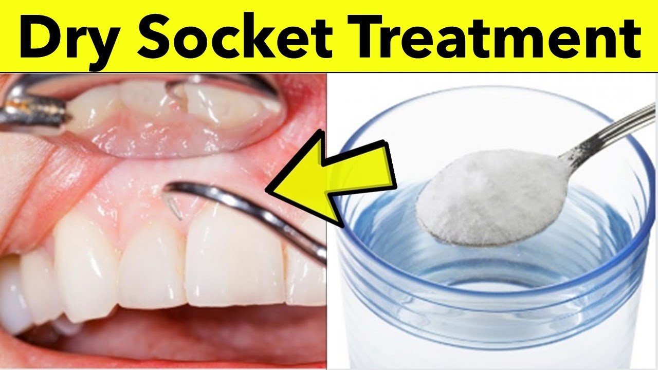 Dry Socket Vs Normal Socket After Tooth Extraction Imgm