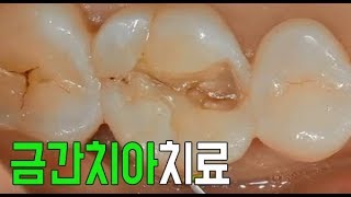 치아크랙 금간치아 치료방법