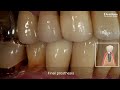 clinical application of dentium implantium ll system