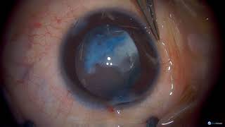 Congenital Membranous Cataract: Dr. Asim Ali