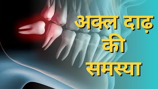 क्या अक्ल दाढ़ निकलवाना जरुरी है? Wisdom Tooth Problems! | इम्पैक्टेड टीथ | Impacted Tooth Hindi