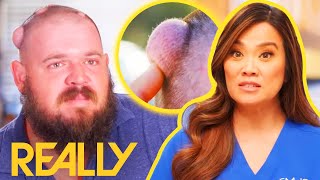 Man's Cyst-Covered Head Is Finally Cleared In Tearful Operation | Dr Pimple Popper
