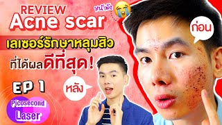 [Review] เลเซอร์หลุมสิว Picosecond Laser แก้หลุมสิว หลุมสิวหายจริง !! ครั้งที่ 1