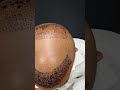 hair transplant surgery