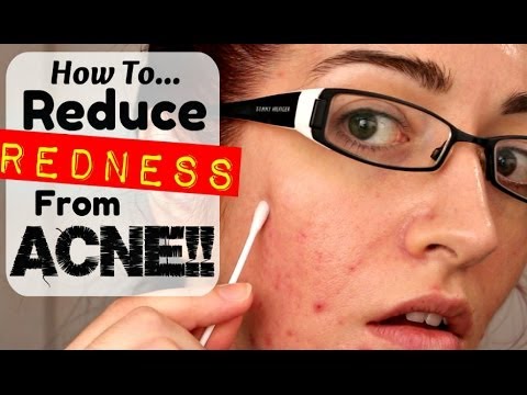 HOW TO: REMOVE REDNESS FROM ACNE & SCARRING! *REQUESTED!* HOW TO: REMOVE REDNESS FROM ACNE & SCARRING! *REQUESTED!*