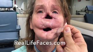 Nasal and Lips Prostheses Hemi-Facial Prosthesis - Before and After