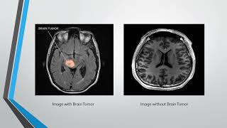 BRAIN TUMOR DETECTION USING SVM