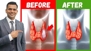 How To Shrink Thyroid Nodules Naturally | Effective Natural Treatment Of Thyroid Nodules
