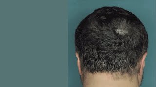 Drug Restores Hair Growth in Patients with Alopecia Areata
