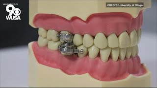 'World's first' weight loss dental device locks mouth shut, forcing a liquid die