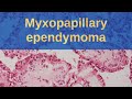 Myxopapillary Ependymoma WHO grade 2 - Pathology mini tutorial