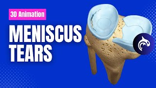 Meniscus Tears - Condition, Treatment, and Surgery - 3D Animation