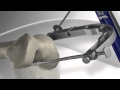 Rikonstruksion i Ligamentit ACL   ACL Reconstruction with Flipcutter™