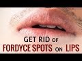 12 Ways To Get Rid Of Fordyce Spots On Lips | Healthspectra