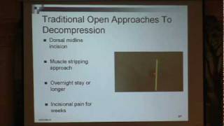 Lumbar Spinal Stenosis Part 3 Neurosurgical Treatment Options Paul Houle, MD