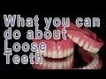 What can be done about loose teeth? What can be done about loose teeth?
