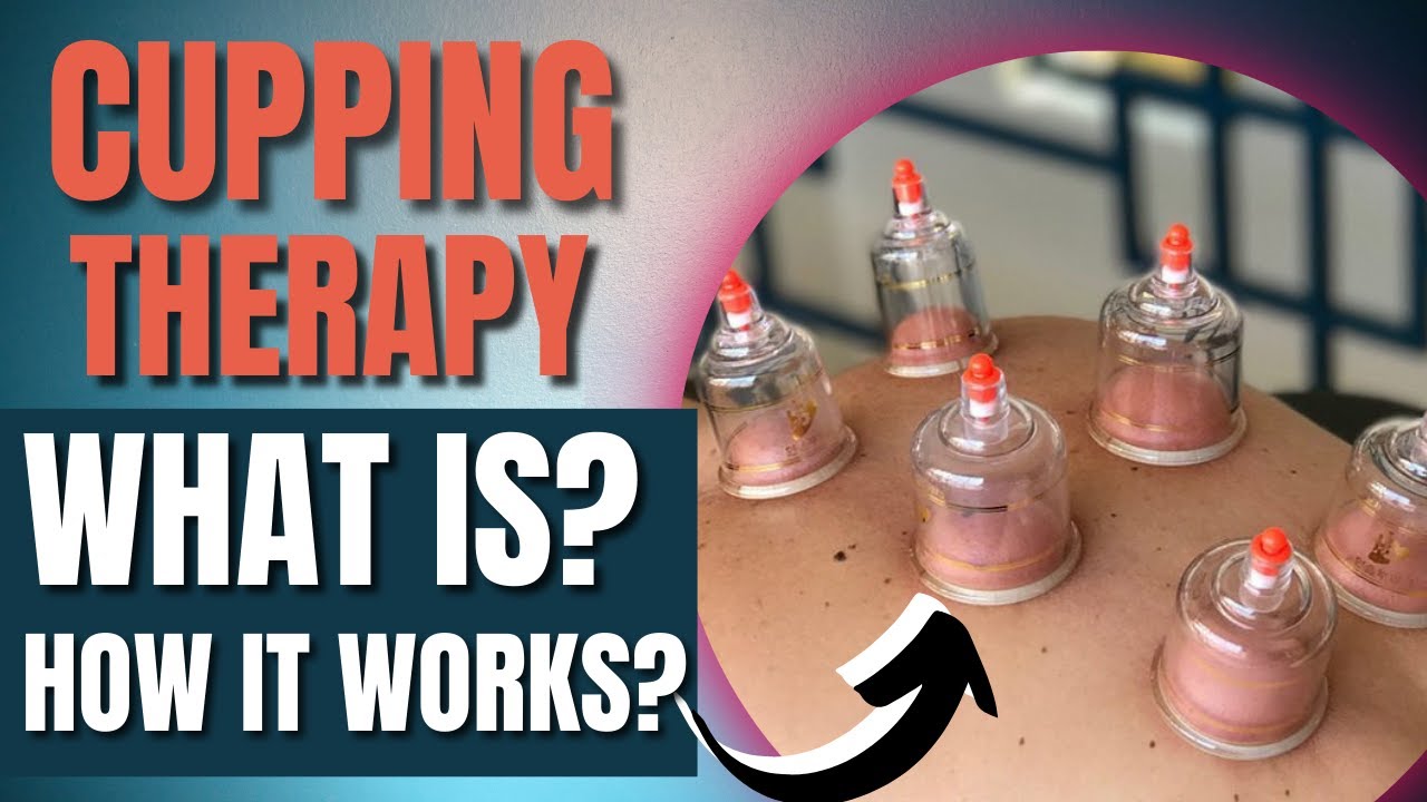 WHAT IS CUPPING THERAPY? HOW DOES IT WORKS? Understanding Everything ...