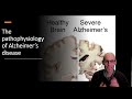 What causes Alzheimer's disease: The pathophysiology of Amyloid.