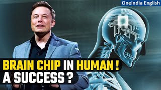 Elon Musk's Neuralink implants brain chip in first human; ‘results promising’, says Musk | Oneindia