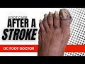 FOOT CARE AFTER A STROKE