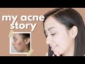 My Acne Story | Journey To Clear Skin (Part 1/3)