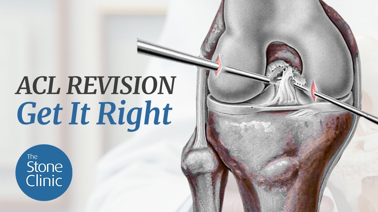 ACL Revision Surgery - The Keys To Getting It Right - YouTube