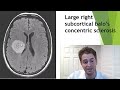 What Symptom Does Each Multiple Sclerosis MRI Lesion Cause  Neurologist Explains