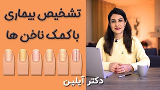 تشخیص بیماریها با تغییرات ناخن ها از دیدگاه دکترآیلین - dr ayliin