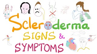 Scleroderma Pathogenesis and Clinical Manifestations (Detailed Explanation)