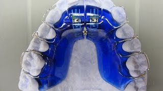 Labialbogen Labial Arch KFO Kieferorthopädie Orthodontics