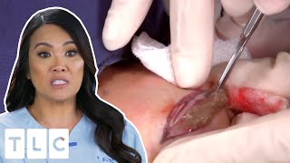 8 DISGUSTING Scenes on Dr  Pimple Popper🤢