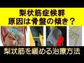 梨状筋症候群は骨盤の傾きが関係する！？梨状筋のタイプと治療方法を解説します！