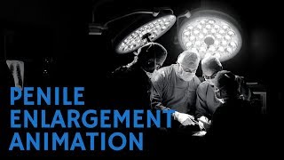 Penuma Penile Enlargement Implant Surgery Animation Video
