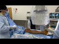 Suprapatellar tibia nailing technique