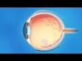 Trabecular Bypass Stent for Glaucoma