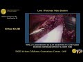 Totally laparoscopic en bloc resection of liver tumor invading diaphragm without a chest tube