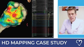 Case Study: Catheter Ablation of Ventricular Tachycardia with HD Mapping