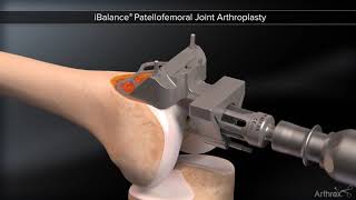 iBalance® Patellofemoral Joint Arthroplasty