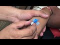 12 year old Cannulation || intravenous cannula fix in 12 year old boy