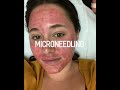 MicroNeedling - Collagen Induction Therapy