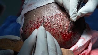 Best Hair Transplant Procedure 2021 | Best Hair Transplant in india | Live Results